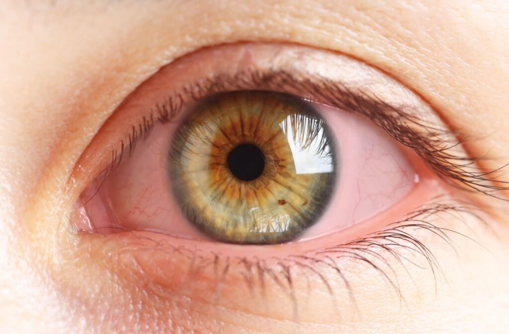 Close-up of an eye with visible irritation and redness, possible due to dry eye syndrome.