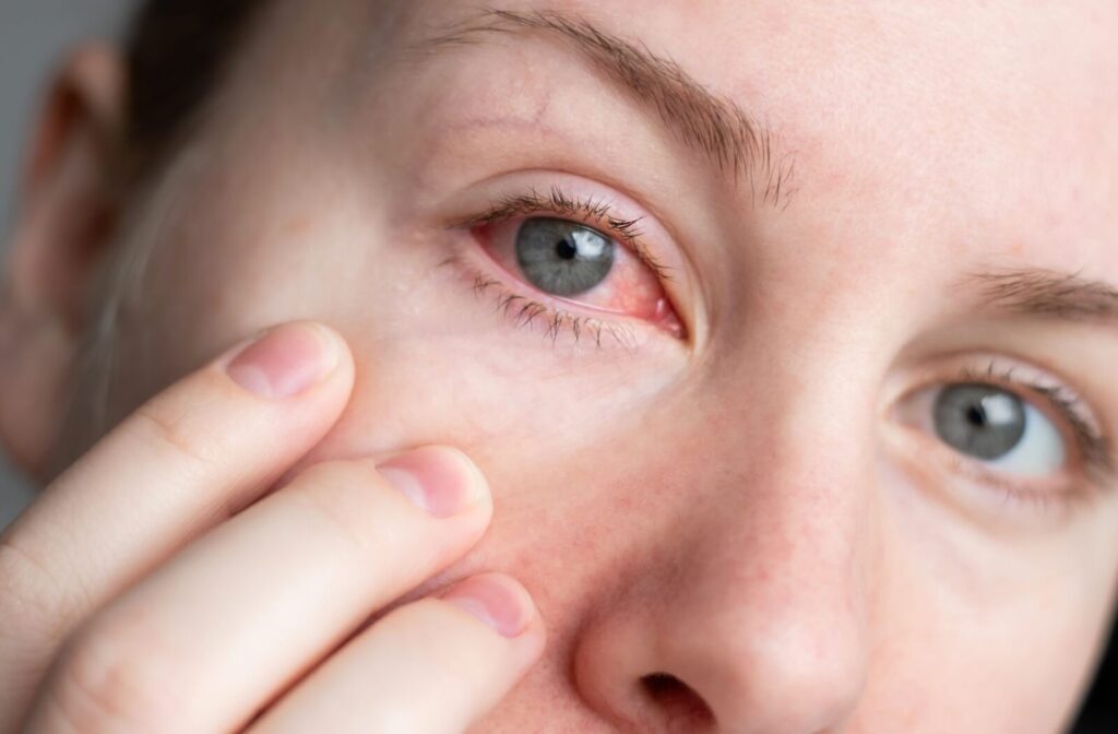 A close-up of a woman examining a bloodshot, red eye in the morning, illustrating symptoms of dry eye, allergies, or eye irritation.